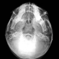 Radiografia de base de craneo. 870003 Idime