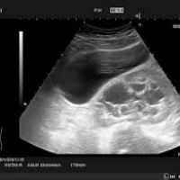 Ecografia abdominal total (higado, pancreas, vesicula, vias biliares, riñones, bazo, grandes vasos, pelvis). Ecografias Bogota (Mandalay)