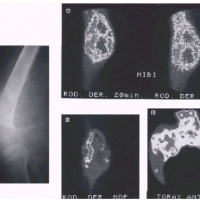 Gamagrafia de viabilidad tumoral con MIBI, Tetroformin. 921301 Idime (2024)