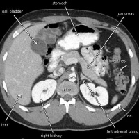 Tomografia axial computada con contraste de abdomen total.879420 Idime