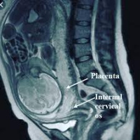 Resonancia nuclear magnetica placenta. EN. Codigo 883443 (2022)