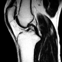 Resonancia nuclear magnetica de articulacion de miembro inferior con contraste (cadera, rodilla, pie o cuello de pie). 883522. Idime