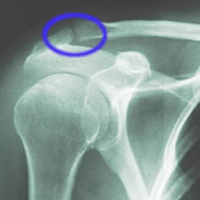 Radiografia de articulaciones acromioclaviculares comparativas. 873202 Idime