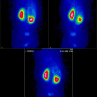 Gamagrafia tumoral con FDG-18.(PET/CT).921302 Idime (2024)