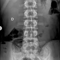 Radiografia de columna dorsolumbar. 871030  Idime