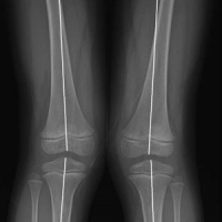 Tomografia computada de miembros inferiores (axiales de rotula o longitud de miembros inferiores) . 879523 Idime (2024)
