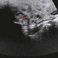 Ecografia de glandulas salivales con transductor de 7 Mhz o mas. EN. Codigo CUPS 881131 (2022)