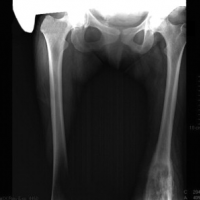 Radiografia de femur AP y lateral. 873312 Idime
