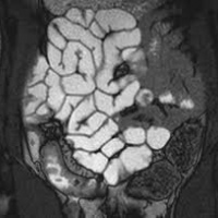 Resonancia nuclear magnetica de intestino delgado contrastada. EN. Codigo 883401-10C (2022)