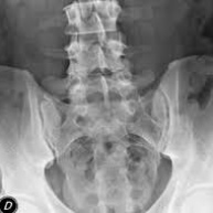 Radiografia de articulaciones sacroiliacas.871091  Idime