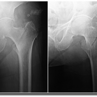 Radiografia de cadera articulacion coxofemoral AP, lateral. 873411 Idime