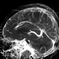 Angiotomografia cerebral. 879901. Idime (2022)