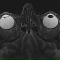 Resonancia nuclear magnetica de orbitas con contraste. 883103. Idime