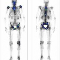 Gamagrafia osea (corporal total o segmentaria). 920901 Idime (2024)