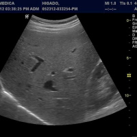Ecografia gluteo. Ecografias Bogota (Ilarco)