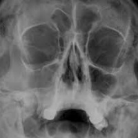 Radiografia de senos paranasales.870108 . Idime