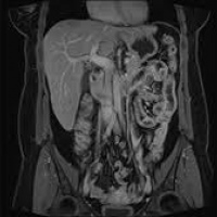 Resonancia nuclear magnetica de abdomen (higado-bazo) con contraste con medicion de hierro. Idime