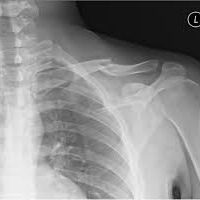 Radiografia de clavicula. 873112  Idime