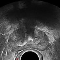 Ecografia de prostata transrectal sin biopsia  881502 Idime