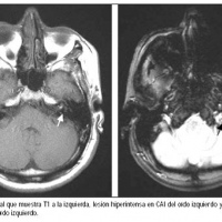 Resonancia nuclear magnetica de oidos contrastada. EN. Codigo CUPS 883109 C (2022)