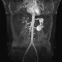 Angiorresonancia de abdomen con contraste.CUPS 883909. Idime (2022)