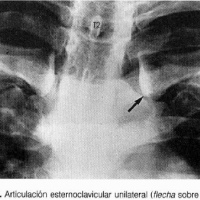 Radiografia de articulaciones esternoclaviculares. 871129 Idime