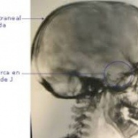 Radiografia de silla turca. 870004  Idime