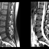 Resonancia nuclear magnetica de columna lumbosacra con contraste. 883230. Idime