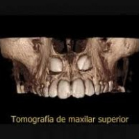 Tomografia computada de maxilares (estudio implantologia). Un maxilar  879141. Idime (2024)