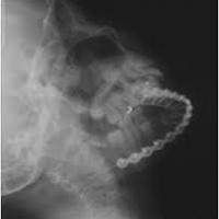Radiografia de maxilar inferior. 870113  Idime