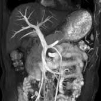 Resonancia nuclear magnetica con angiografia de abdomen.883909 Idime