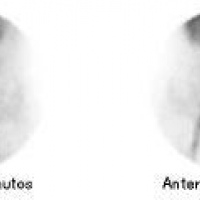 Gamagrafia en hemorragia digestiva con eritrocitos marcados. 920602  Idime (2024)