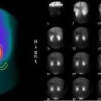 Renograma basal y post-captopril. 920808 . Se aplican dos dosis de DTPA Idime (2024)