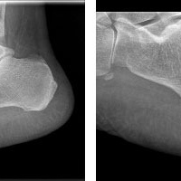 Radiografia de calcaneo axial y lateral.873335  Idime