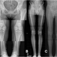 Test de Farril (Rx medicion de miembros inferiores). 873302 Estudio pie plano, pies con apoyo. Idime