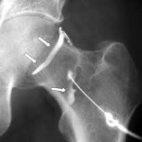 Artrorresonancia de cadera. 878811 Idime