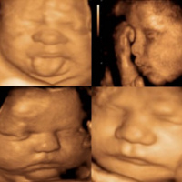 Ecografia obstetrica con detalle anatomico. 881437 Idime