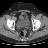 Tomografia axial computada con contraste de pelvis. 879460 Idime