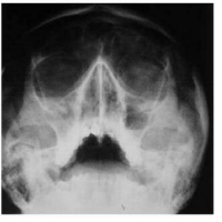 Radiografia de huesos nasales.870107 Idime