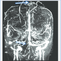 Angiorresonancia de torax (sin incluir corazon). 883341 Idime