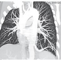 Angiotomografia de venas pulmonares. 879901 Idime. (2024)