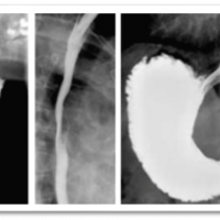 Radiografia de vias digestivas altas (esofago, estomago, duodeno). 872121 Idime