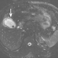 Colangiografia con contraste por resonancia nuclear magnetica.883434 Idime