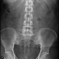 Radiografia de abdomen simple. 872002 Idime