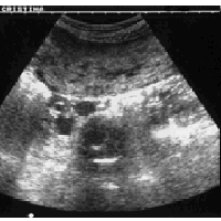 Ecografia masas abdominales y retroperitoneo. Ecografias Bogota (Mandalay)