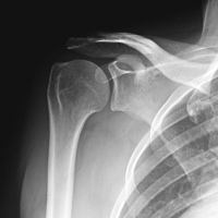 Radiografia de hombro. 873204. Idime
