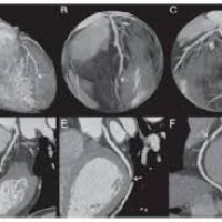 Tomografia computada de coronarias (ANGIOTC CORONARIO).879902  Idime (2024)