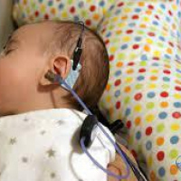 Potenciales evocados auditivos de latencia media y latencia tardia. 954630. Audiosalud. (2022)