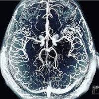 Angiorresonancia de cerebro. CUPS 883908 (2022)