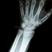 Radiografia de muñeca.873206  Idime